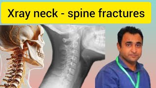 cervical spine fractures radiology  part 2 [upl. by Renaud]