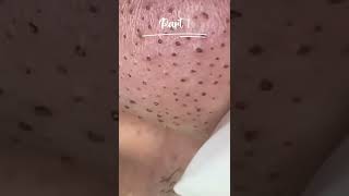 Blackhead amp sebaceous filaments extractions shorts skincare [upl. by Zabrina]