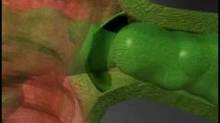 Sphincter of Oddi Dysfunction [upl. by Gibby414]