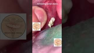 Tonsil Stone REMOVAL AT HOME [upl. by Neelyaj825]