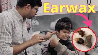 Earwax Removal from children  How to remove hard wax from small children  Video otoscaopy [upl. by Lepp838]