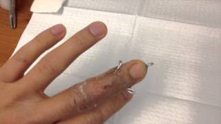 Broken finger pin removal [upl. by Cicily491]