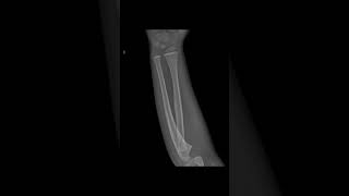 Torus fracture of the radius xray shoets [upl. by Llet]