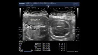 Ultrasound Video showing Oligohydromnios loss of fetal movements with Pregnancy of about 22 weeks [upl. by Barr]