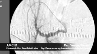 Interventional Radiology Liver Shunt Embolization [upl. by Buehler]