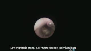 Lower Ureteric Stone 45Fr Ureteroscopy amp Holmium Laser [upl. by Ede]