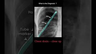 Chest drain  close up 198 chest Xray tubes Quiz radiologychannel007 [upl. by Aynotal]