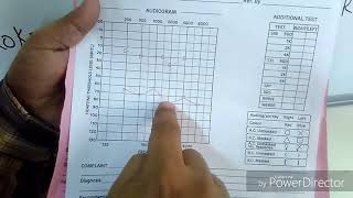 How to interpret a Pure Tone Audiogram PTA [upl. by Farland962]