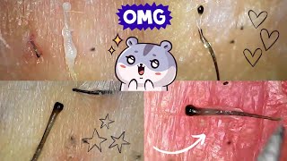 Satisfying Hair Follicle Plucks Hair Root Removal Under Microscope [upl. by Gabbie]