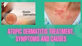 Atopic dermatitis treatment symptoms and causes  Nuse Healthy [upl. by Shaia]