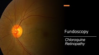 Chloroquine Retinopathy Fundoscopy [upl. by Nodgnal]