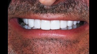 Video Procedure of Dental Veneers after Invisalign at Cosmetic Dental Associates [upl. by Irep]