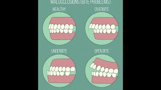 Different Types of Malocclusions [upl. by Martelli]