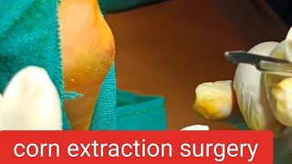 corn extraction surgery  corn callus removal surgery  doctor youtube dr [upl. by Anomar148]