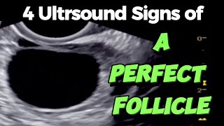 A Perfect Follicle  4 Ultrasound Signs  of Good Follicle for Easy Conceiving [upl. by Marasco203]