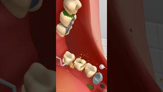 mouth Tooth Treatments Big stone removal dirt asmr shortsfeed short shorts animation mouth [upl. by Sedgewick668]