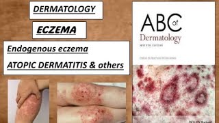 DERMATOLOGY  ENDOGENOUS ECZEMA  Atopic dermatitis amp other types derma eczema dermatitis [upl. by Ximenes]