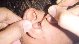 Something Stuck in Mans Ear for Months  What Is It [upl. by Bland362]