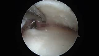 Medial meniscal root repair simplified centralisation technique [upl. by Ellehcor578]