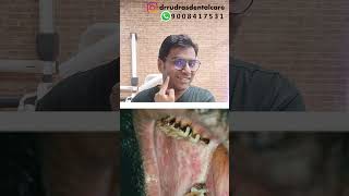 Dr Rudra Mohan Oral Sub Mucous FibrosisOSMFdrrudrasdentalcare drrudramohan osmf osmftreatment [upl. by Trula]