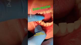 Tooth Crown Insertion [upl. by Amilah]