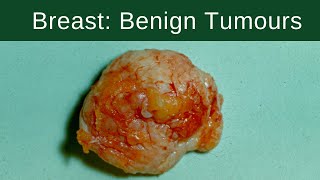 Breast Benign Tumours  Pathology mini tutorial [upl. by Willabella678]