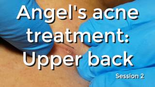 Angels Acne Treatment Upperback  Session 2 [upl. by Bunni]