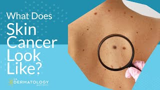 What Does Skin Cancer Look Like [upl. by Oderfla]