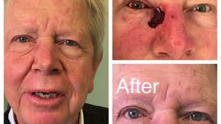 Eyelid Skin Cancer Reconstruction Surgery [upl. by Yruama]