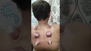 Cupping Therapy Does It Really Work for Neck Pain [upl. by Eirrahs]