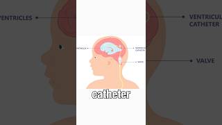 NPH symptoms diagnosis and treatment normal pressure hydrocephalus [upl. by Gingras]