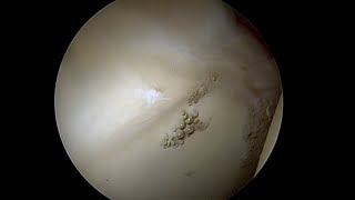 Debonded Articular Cartilage Lifting off the Bone as Labrum is Stressed [upl. by Bonar947]