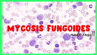 Mycosis Fungoides  WBC disorders  Sezary Syndrome [upl. by Federico]