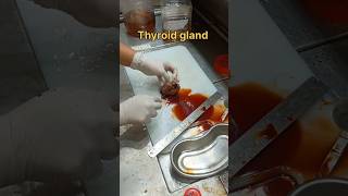 Cystic thyroid gland gross pathology [upl. by Yevoc1]