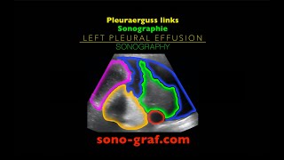 Sonographie  Pleuraerguss links [upl. by Sugden]