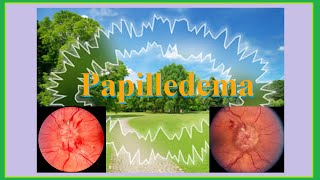 papilledema [upl. by Safko673]