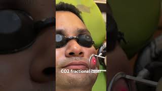 CO2 fractional laser co2 bollywood music laser treatment shorts dransharma hairregeneration [upl. by Roda]