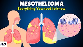 Mesothelioma – Causes Signs and Symptoms Diagnosis amp Treatment [upl. by Buyse]