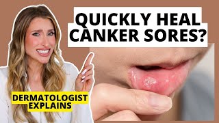 Quickly Heal Canker Sores How to Prevent amp Heal Them Faster  Dermatologist Explains [upl. by Lyrrehs328]