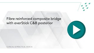 Fibre reinforced composite bridge with everStick CampB posterior [upl. by Ah752]