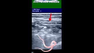 Long Ascaris Worm  in Small Intestine of 8 yrs Old Boy ultrasound [upl. by Agustin]