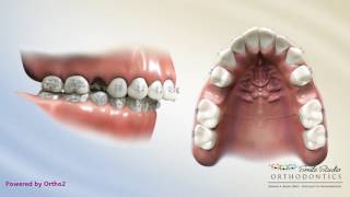 Upper 2nd Bicuspid Extraction  Overjet  Orthodontic Treatment [upl. by Hardunn]