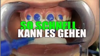 SO SCHNELL wird die FESTE ZAHNSPANGE eingesetzt  Orthodentix [upl. by Hsihsa]