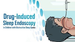 DrugInduced Sleep Endoscopy in Children with Obstructive Sleep Apnea [upl. by Swartz]