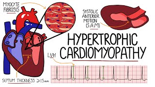 Hypertrophic Cardiomyopathy Made Easy  Includes Hypertrophic Obstructive Cardiomyopathy amp SAM [upl. by Ahsena]