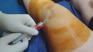 Knee fluid removal  Arthrocentesis  Synovial fluid aspiration procedure [upl. by Hortensa]