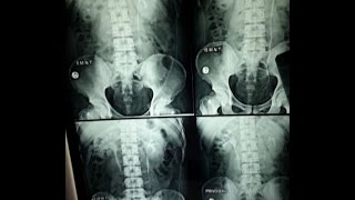 IVPIVU Intravenous UrographyPyelography BASICS OF RADIOGRAPH EXPLAINED [upl. by Nahpos886]