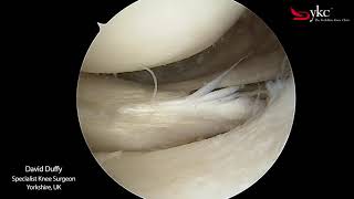 Watch a Knee Surgeon Treat a Meniscal Tear [upl. by Ainud]