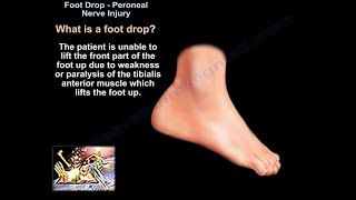 Foot Drop Peroneal Nerve Injury  Everything You Need To Know  Dr Nabil Ebraheim [upl. by Lindahl]