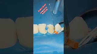 Composite BONDING teeth [upl. by Wallache678]